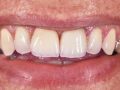 Zubne ljuske za prekrasan osmijeh