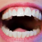 Bijeljenje zubova za trajne i vidljive rezultate