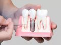 Zubni implantati vraćaju osmijeh