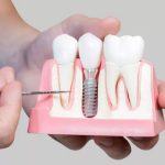visokokvalitetni zubni implantati