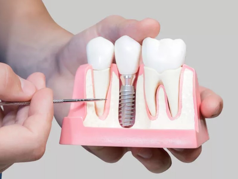 visokokvalitetni zubni implantati