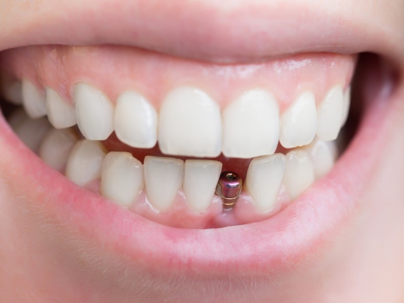 Zubni implantati su trajno rješenje.